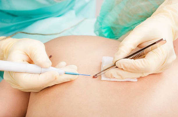 عملية إزالة الشامة وأهم المضاعفات الممكنة